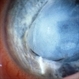 Traumatic cataract Traumatic cataract